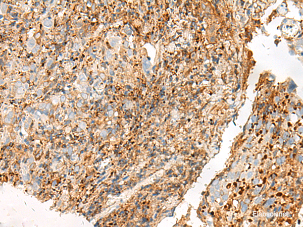 Immunohistochemistry of paraffin-embedded Human cervical cancer tissue using GPR27 Polyclonal Antibody at dilution of 1:25(×200)