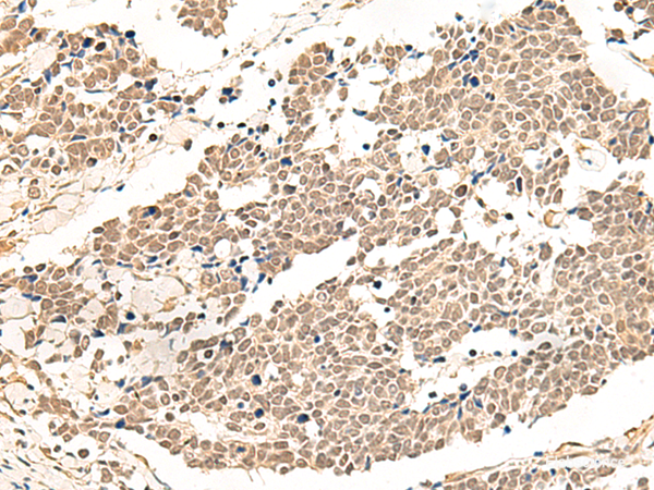 Immunohistochemistry of paraffin-embedded Human lung cancer tissue using GPR139 Polyclonal Antibody at dilution of 1:50(×200)