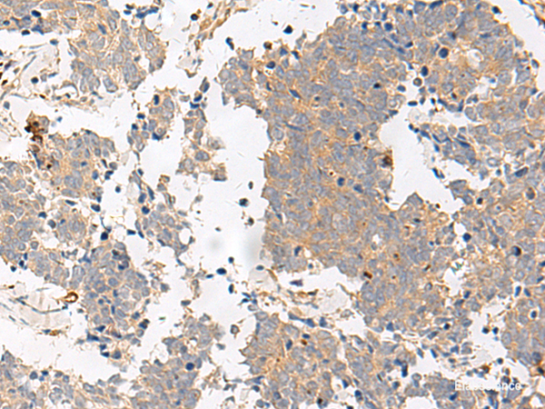 Immunohistochemistry of paraffin-embedded Human lung cancer tissue using GPR153 Polyclonal Antibody at dilution of 1:40(×200)