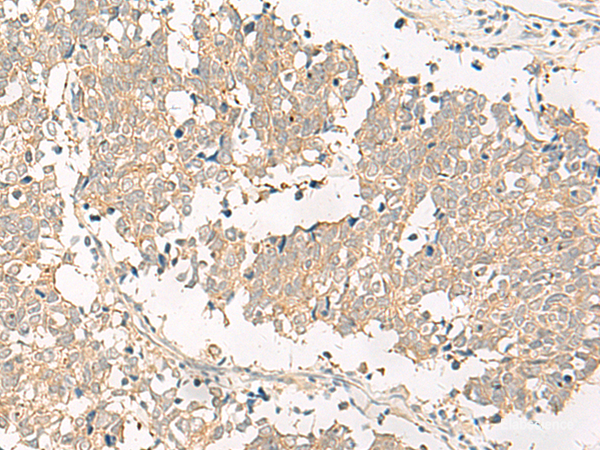 Immunohistochemistry of paraffin-embedded Human lung cancer tissue using GPR161 Polyclonal Antibody at dilution of 1:40(×200)