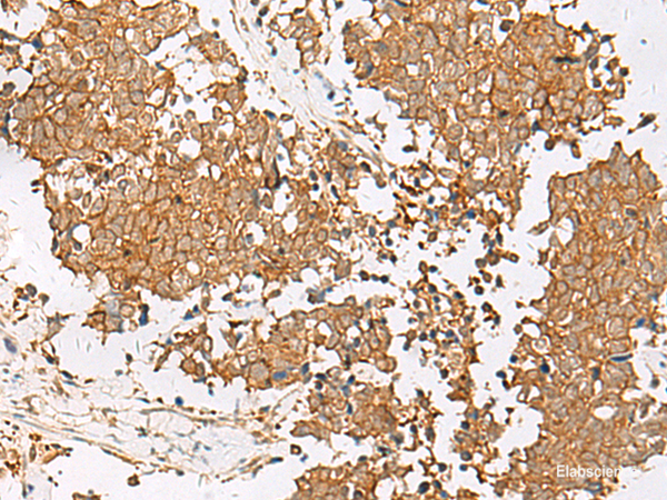 Immunohistochemistry of paraffin-embedded Human lung cancer tissue using GSTM2 Polyclonal Antibody at dilution of 1:50(×200)