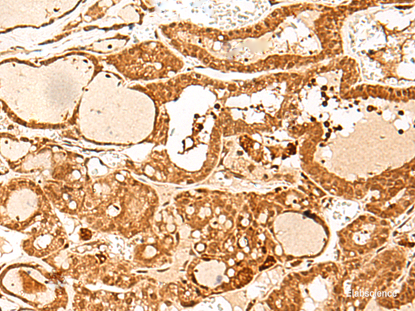 Immunohistochemistry of paraffin-embedded Human thyroid cancer tissue using GTF3C3 Polyclonal Antibody at dilution of 1:30(×200)