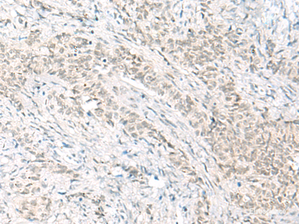 Immunohistochemistry of paraffin-embedded Human ovarian cancer tissue using HABP4 Polyclonal Antibody at dilution of 1:60(×200)