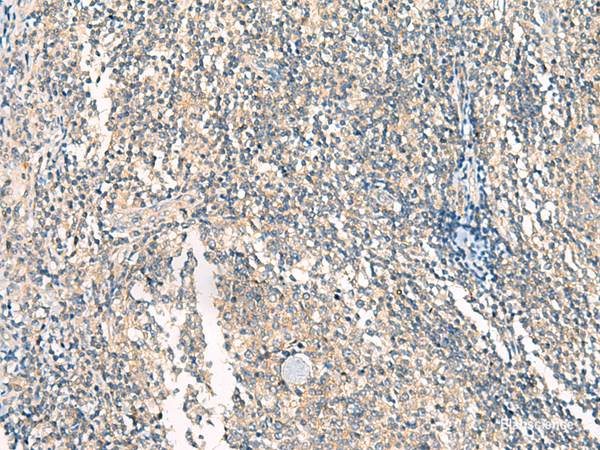 Immunohistochemistry of paraffin-embedded Human tonsil tissue using HASPIN Polyclonal Antibody at dilution of 1:45(×200)