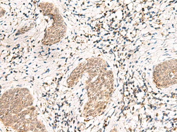 Immunohistochemistry of paraffin-embedded Human esophagus cancer tissue using SNRPG Polyclonal Antibody at dilution of 1:40(×200)
