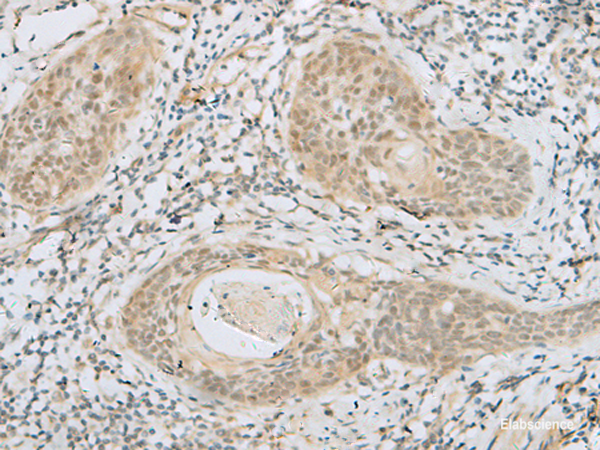 Immunohistochemistry of paraffin-embedded Human esophagus cancer tissue using HELT Polyclonal Antibody at dilution of 1:40(×200)