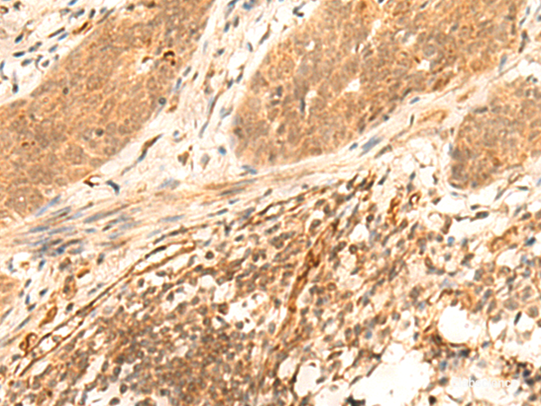 Immunohistochemistry of paraffin-embedded Human esophagus cancer tissue using HES7 Polyclonal Antibody at dilution of 1:25(×200)