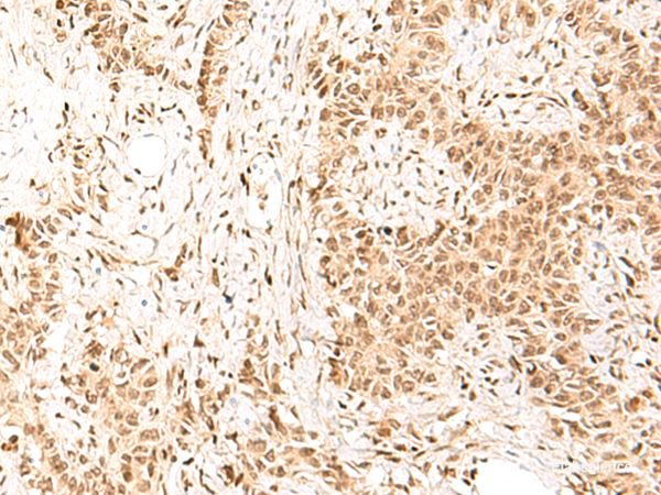 Immunohistochemistry of paraffin-embedded Human ovarian cancer tissue using HIST1H1D Polyclonal Antibody at dilution of 1:55(×200)
