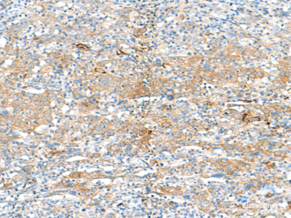 Immunohistochemistry of paraffin-embedded Human cervical cancer tissue using HLA-DRB3 Polyclonal Antibody at dilution of 1:50(×200)