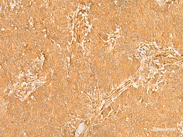 Immunohistochemistry of paraffin-embedded Human breast cancer tissue using KRT76 Polyclonal Antibody at dilution of 1:50(×200)