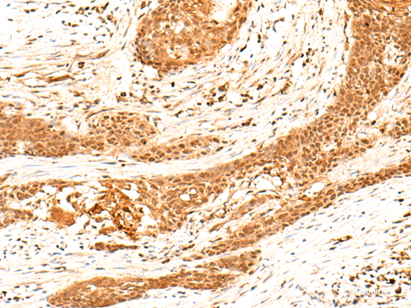 Immunohistochemistry of paraffin-embedded Human esophagus cancer tissue using HNF4A Polyclonal Antibody at dilution of 1:40(×200)