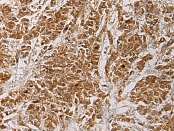 Immunohistochemistry of paraffin-embedded Human colorectal cancer tissue using HOXC5 Polyclonal Antibody at dilution of 1:55(×200)