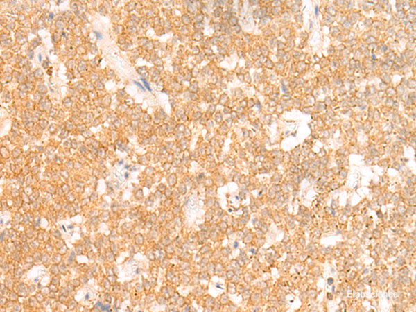 Immunohistochemistry of paraffin-embedded Human ovarian cancer tissue using RRP8 Polyclonal Antibody at dilution of 1:50(×200)