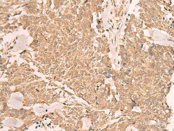 Immunohistochemistry of paraffin-embedded Human lung cancer tissue using IL1RAPL2 Polyclonal Antibody at dilution of 1:25(×200)