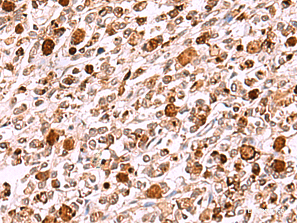 Immunohistochemistry of paraffin-embedded Human gastric cancer tissue using INO80 Polyclonal Antibody at dilution of 1:85(×200)