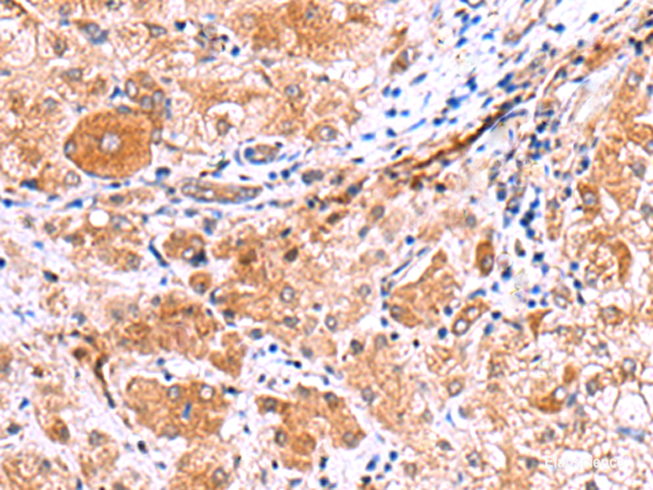 Immunohistochemistry of paraffin-embedded Human liver cancer tissue using IRGC Polyclonal Antibody at dilution of 1:30(×200)