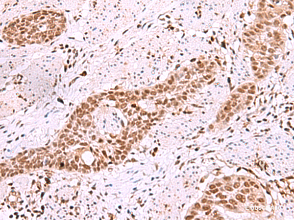 Immunohistochemistry of paraffin-embedded Human esophagus cancer tissue using ISL2 Polyclonal Antibody at dilution of 1:40(×200)
