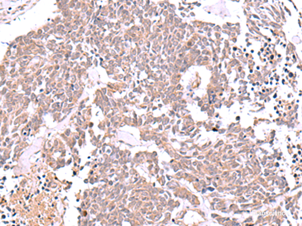 Immunohistochemistry of paraffin-embedded Human lung cancer tissue using JDP2 Polyclonal Antibody at dilution of 1:40(×200)