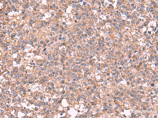 Immunohistochemistry of paraffin-embedded Human tonsil tissue using MAPK8IP3 Polyclonal Antibody at dilution of 1:45(×200)