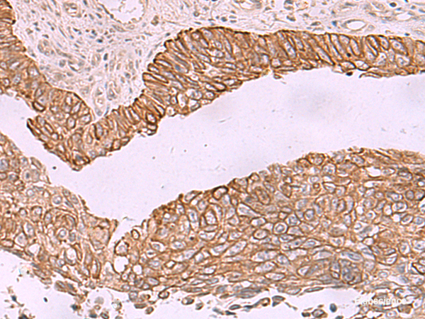 Immunohistochemistry of paraffin-embedded Human lung cancer tissue using KCNK12 Polyclonal Antibody at dilution of 1:60(×200)