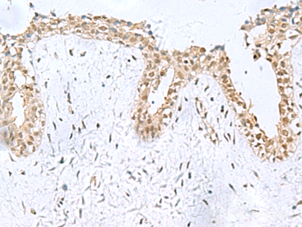 Immunohistochemistry of paraffin-embedded Human breast cancer tissue using KDM2B Polyclonal Antibody at dilution of 1:50(×200)