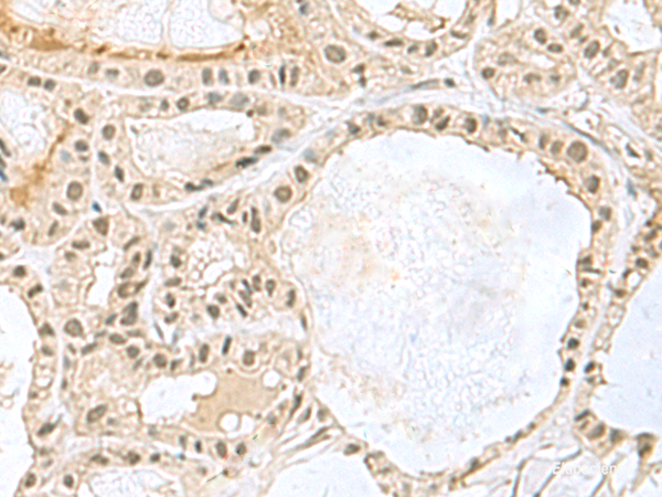Immunohistochemistry of paraffin-embedded Human thyroid cancer tissue using KDM3B Polyclonal Antibody at dilution of 1:45(×200)
