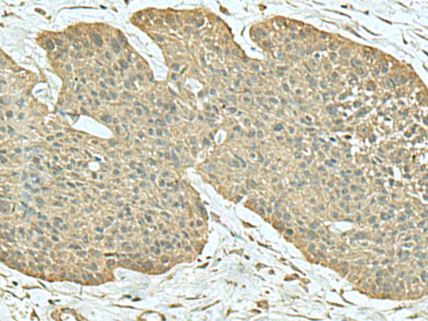 Immunohistochemistry of paraffin-embedded Human esophagus cancer tissue using FN3KRP Polyclonal Antibody at dilution of 1:55(×200)