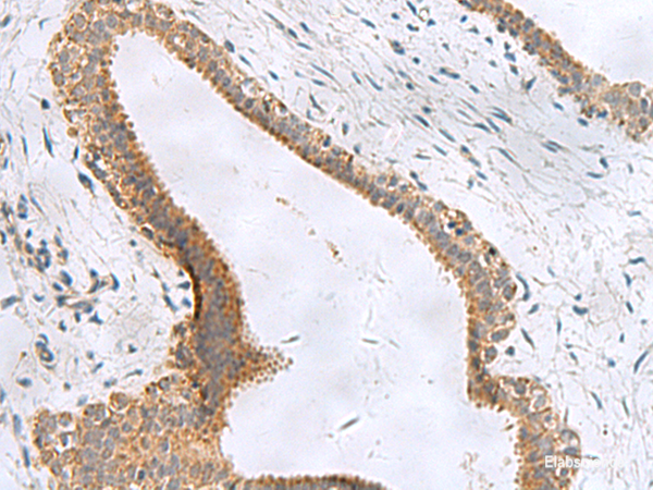 Immunohistochemistry of paraffin-embedded Human breast cancer tissue using CEMIP Polyclonal Antibody at dilution of 1:120(×200)