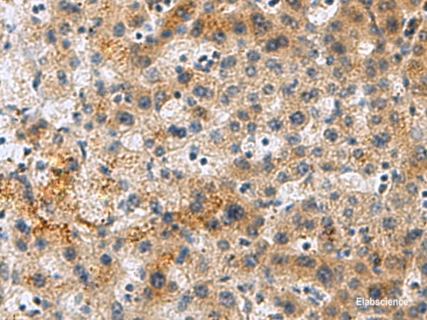 Immunohistochemistry of paraffin-embedded Human liver cancer tissue using PLIN4 Polyclonal Antibody at dilution of 1:50(×200)