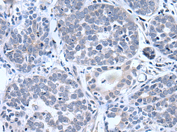 Immunohistochemistry of paraffin-embedded Human esophagus cancer tissue using BTG4 Polyclonal Antibody at dilution of 1:55(×200)