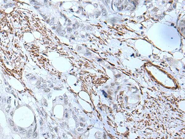Immunohistochemistry of paraffin-embedded Human colorectal cancer tissue using GJA5 Polyclonal Antibody at dilution of 1:50(×200)