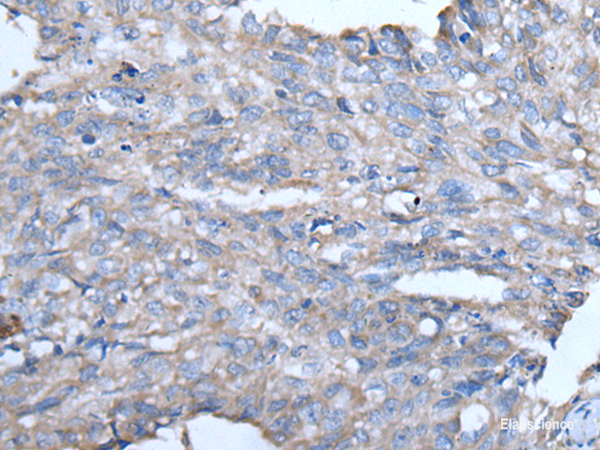 Immunohistochemistry of paraffin-embedded Human lung cancer tissue using GJA1 Polyclonal Antibody at dilution of 1:50(×200)