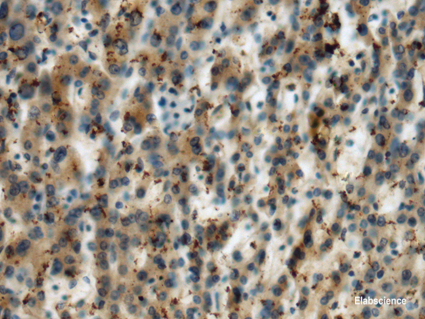 Immunohistochemistry of paraffin-embedded Human liver cancer tissue using MICA Polyclonal Antibody at dilution of 1:60(×200)