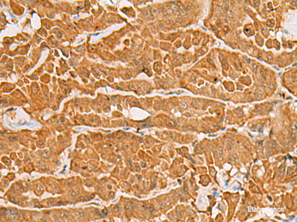 Immunohistochemistry of paraffin-embedded Human thyroid cancer tissue using MAPK14 Polyclonal Antibody at dilution of 1:60(×200)