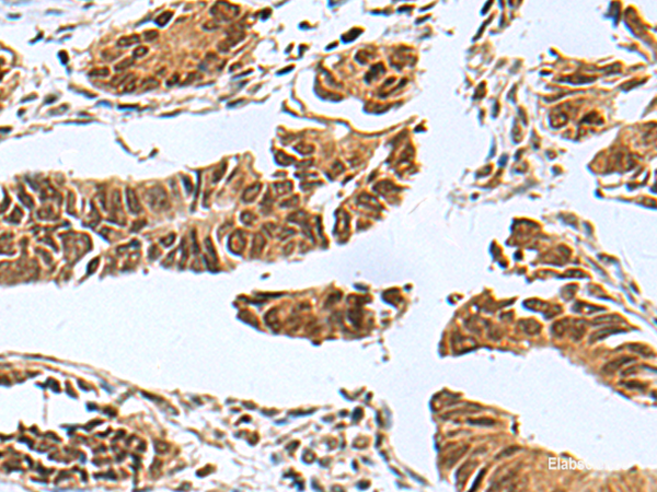 Immunohistochemistry of paraffin-embedded Human colorectal cancer tissue using PDCD5 Polyclonal Antibody at dilution of 1:55(×200)