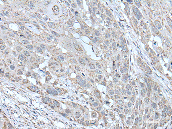 Immunohistochemistry of paraffin-embedded Human esophagus cancer tissue using SCNN1G Polyclonal Antibody at dilution of 1:40(×200)