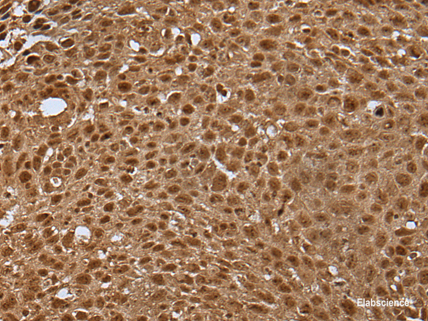 Immunohistochemistry of paraffin-embedded Human lung cancer tissue using LAMTOR5 Polyclonal Antibody at dilution of 1:35(×200)