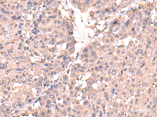 Immunohistochemistry of paraffin-embedded Human liver cancer tissue using HPN Polyclonal Antibody at dilution of 1:50(×200)