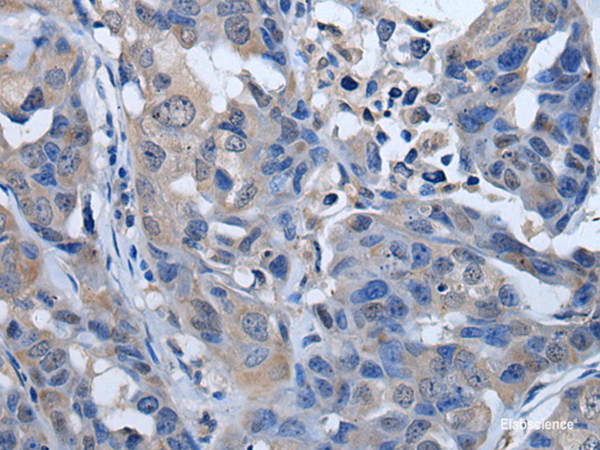 Immunohistochemistry of paraffin-embedded Human breast cancer tissue using PLK4 Polyclonal Antibody at dilution of 1:50(×200)