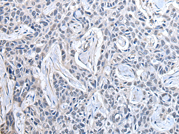 Immunohistochemistry of paraffin-embedded Human lung cancer tissue using PPIG Polyclonal Antibody at dilution of 1:50(×200)