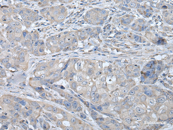 Immunohistochemistry of paraffin-embedded Human breast cancer tissue using RASA1 Polyclonal Antibody at dilution of 1:40(×200)