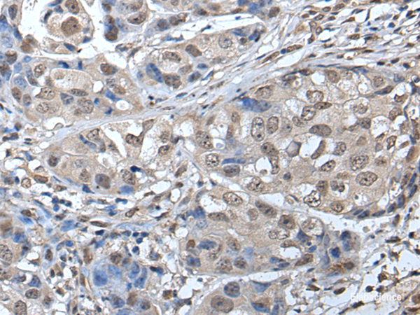 Immunohistochemistry of paraffin-embedded Human breast cancer tissue using SMC1A Polyclonal Antibody at dilution of 1:45(×200)