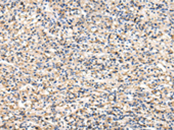 Immunohistochemistry of paraffin-embedded Human prost at e cancer tissue using VCAM1 Polyclonal Antibody at dilution of 1:30(×200)