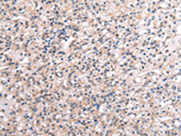 Immunohistochemistry of paraffin-embedded Human liver cancer tissue using RNF115 Polyclonal Antibody at dilution of 1:45(×200)