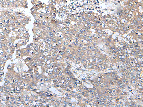 Immunohistochemistry of paraffin-embedded Human liver cancer tissue using BRMS1L Polyclonal Antibody at dilution of 1:45(×200)