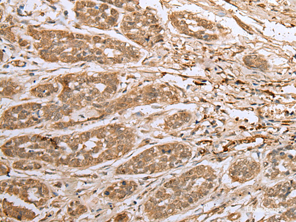 Immunohistochemistry of paraffin-embedded Human esophagus cancer tissue using ATXN7L3 Polyclonal Antibody at dilution of 1:40(×200)