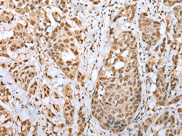 Immunohistochemistry of paraffin-embedded Human breast cancer tissue using ZNF486 Polyclonal Antibody at dilution of 1:50(×200)