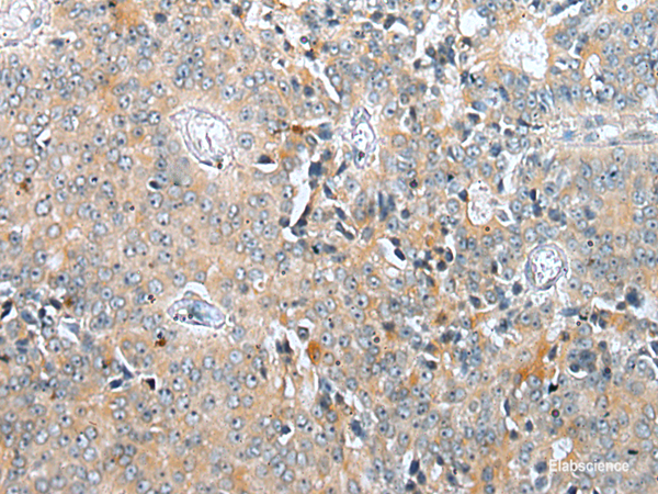 Immunohistochemistry of paraffin-embedded Human prost at e cancer tissue using COMMD6 Polyclonal Antibody at dilution of 1:45(×200)