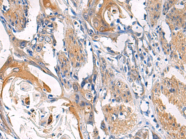 Immunohistochemistry of paraffin-embedded Human esophagus cancer tissue using LYPLA1 Polyclonal Antibody at dilution of 1:45(×200)