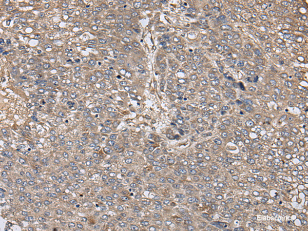 Immunohistochemistry of paraffin-embedded Human liver cancer tissue using ZFP36 Polyclonal Antibody at dilution of 1:40(×200)